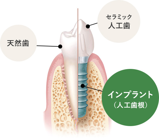 インプラントとは