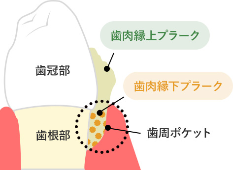 歯周病の原因となるプラークの説明